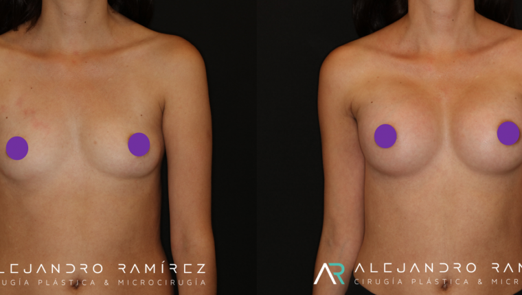 Breast augmentation without scars