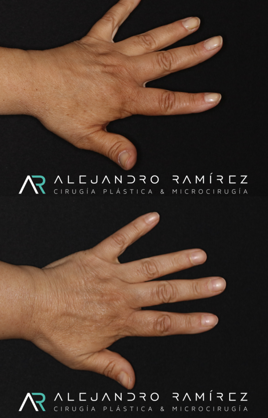 Hand and lymphedema